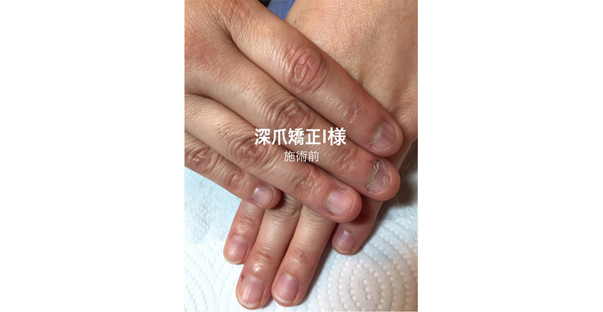 深爪矯正 宮崎県のネイルサロン Star Sapphire 深爪矯正 宮崎県のネイルサロン Star Sapphire