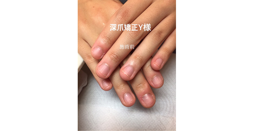 深爪矯正 宮崎県のネイルサロン Star Sapphire 深爪矯正 宮崎県のネイルサロン Star Sapphire